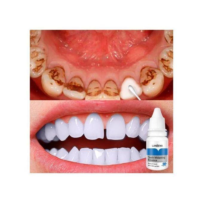 tooth-whittening-essence